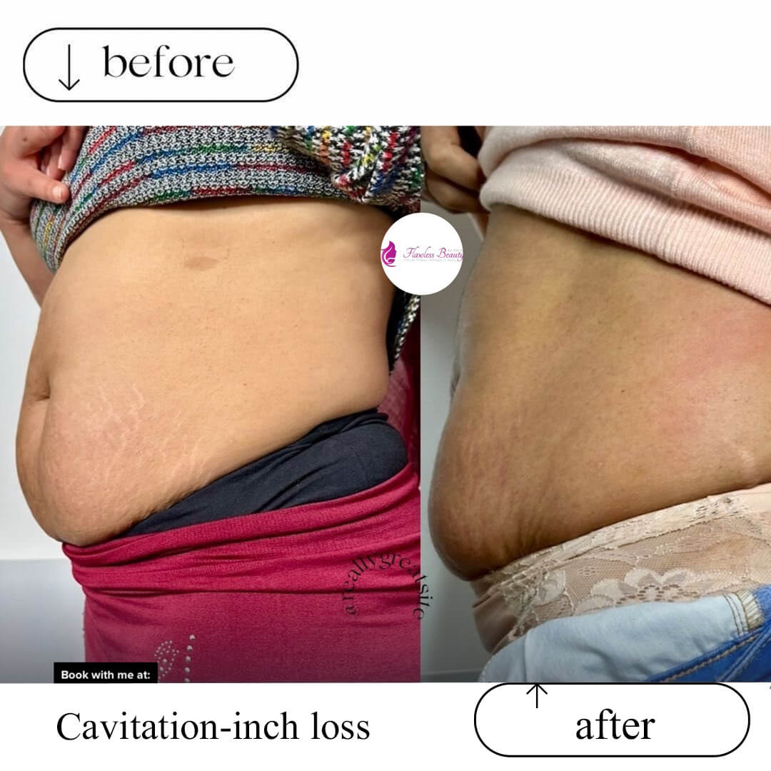 Cavitation-inch loss 1(3)