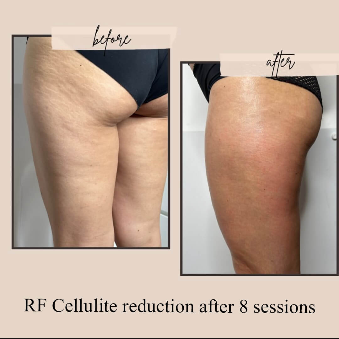 RF Cellulite reduction after 8 sessions(1)