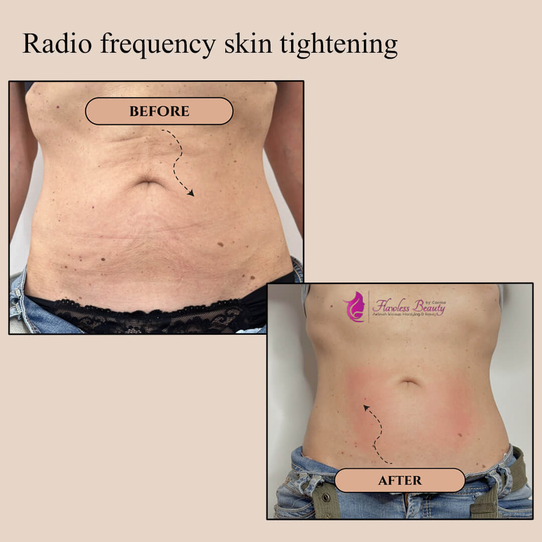 Radio frequency skin tightening(1)